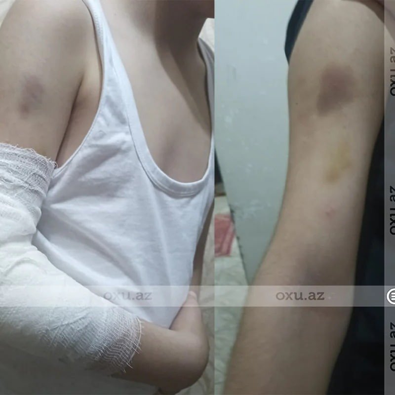 Bakıda məktəblinin sinif yoldaşını yandırdığı bildirilir