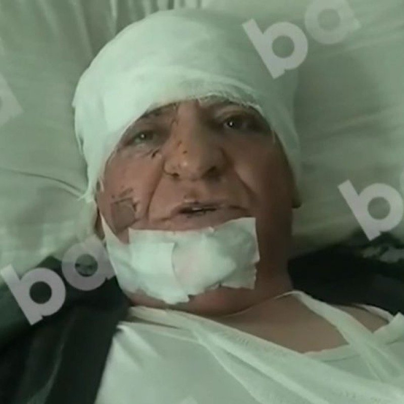 Nərimanovdakı partlayışda yaralanan şəxs: "Hamı töküldü üstümə, məni qan aparırdı"